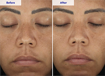 Risultati visibili utilizzo programma anti-età ZO Skin Health retinolo