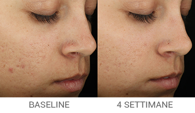 Prima e Dopo Complexion Clarifying Serum